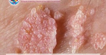 Dấu hiệu, triệu chứng, biểu hiện bệnh sùi mào gà nam và nữ