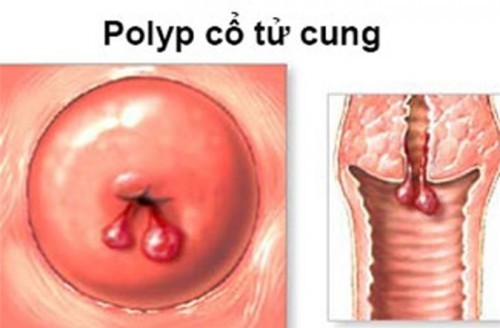 Có nguy hiểm khi bị polyp cổ tử cung
